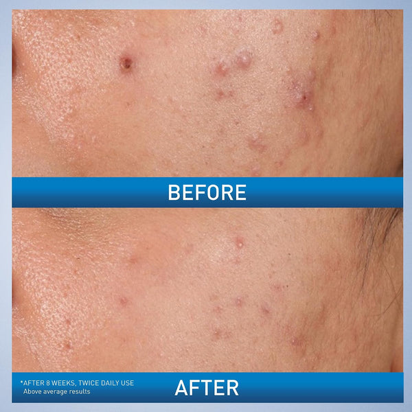 CeraVe Acne Control Gel, 2% Salicylic Acid Treatment With Glycolic Acid + Lactic Acids + Niacniamide, Acne Gel Helps Clear Blemishes Without Over Drying, Alcohol Free & Oil Free, 1.35 Fl Oz