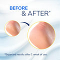 Dr. Scholl's Severe Cracked Heel Repair Restoring Balm 2.5oz, with 25% Urea for Dry, Cracked Feet, Heals and Moisturizes for Healthy Feet, Epsom Salt Soothes, Safe for Diabetics, 3-pack