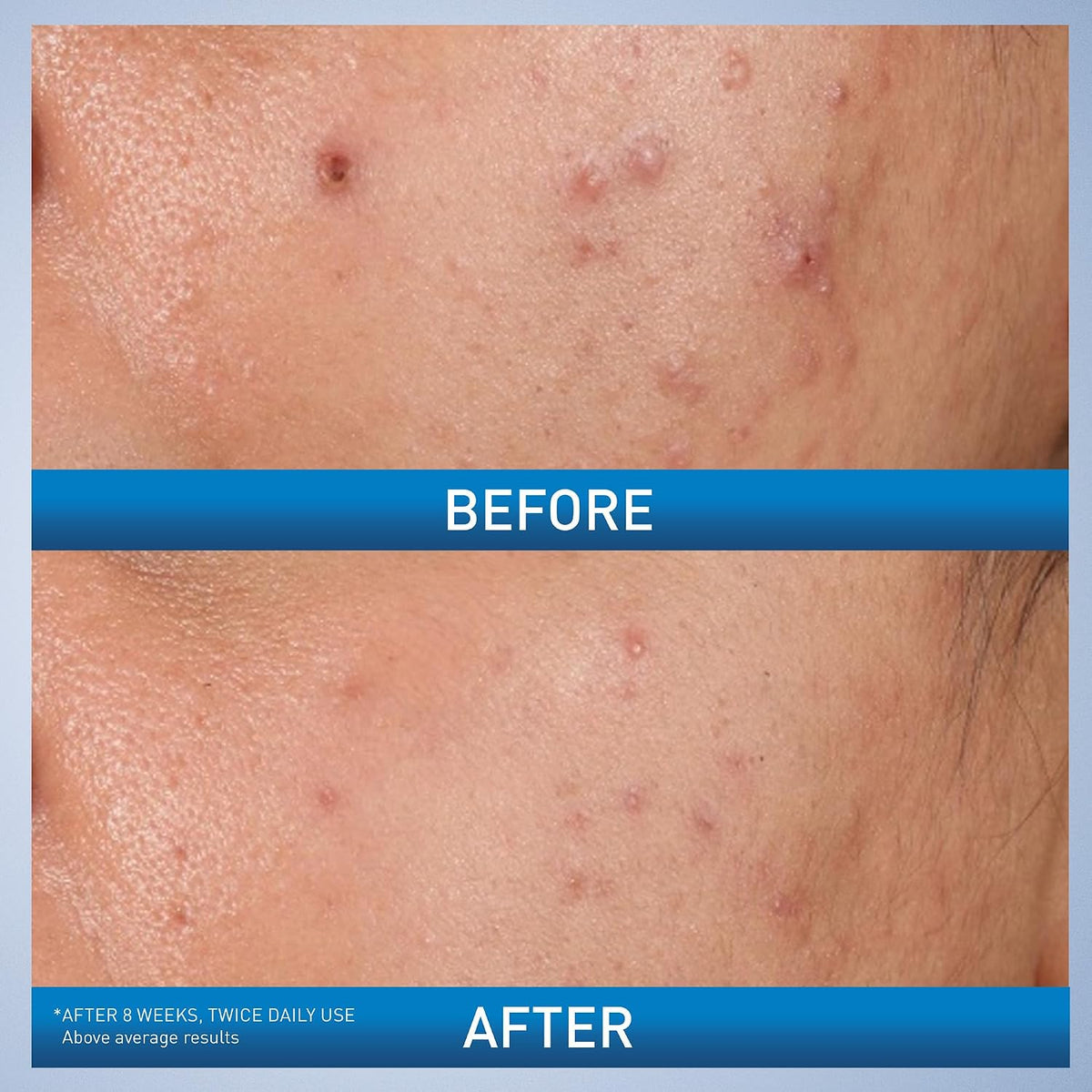 CeraVe Acne Control Gel, 2% Salicylic Acid Treatment With Glycolic Acid + Lactic Acids + Niacniamide, Acne Gel Helps Clear Blemishes Without Over Drying, Alcohol Free & Oil Free, 1.35 Fl Oz