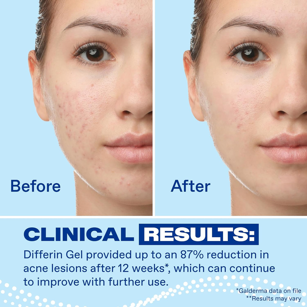 Differin Acne Treatment Gel, 90 Day Supply, Retinoid Treatment for Face with 0.1% Adapalene, Gentle Skin Care for Acne Prone Sensitive Skin, 45g Pump (Packaging May Vary)