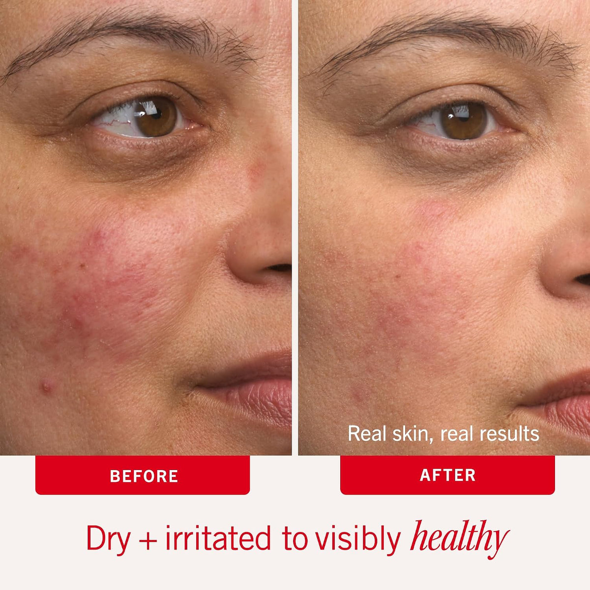 First Aid Beauty Ultra Repair Cream, Intense Hydration - Clinically Tested Face & Body Moisturizer with Colloidal Oatmeal - Supports Eczema & Dry Skin Barrier Repair - Fragrance Free